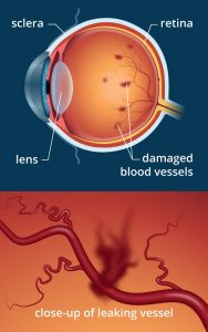 Leakage of blood vessels due to diabetes