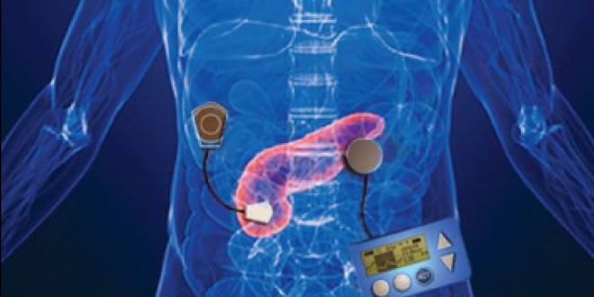 Artificial Pancreas Diabetes Management