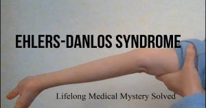 ehlers danlos syndrome