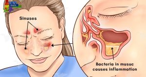 bacterial infection