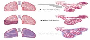 kinds of Pneumonia