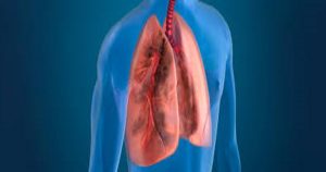 Multifocal Pneumonia