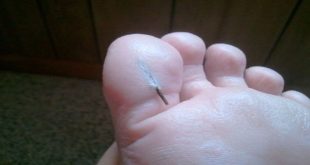 hair splinters on foot