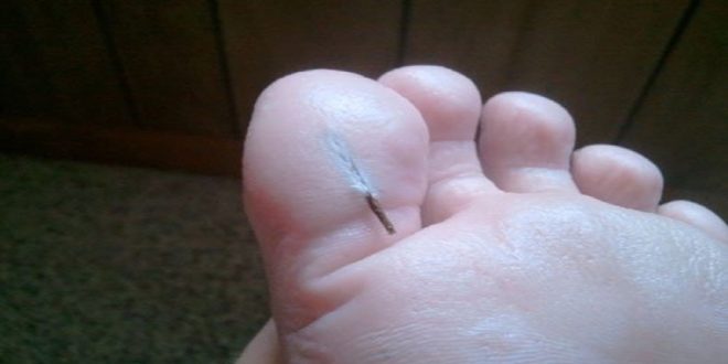 hair splinters on foot